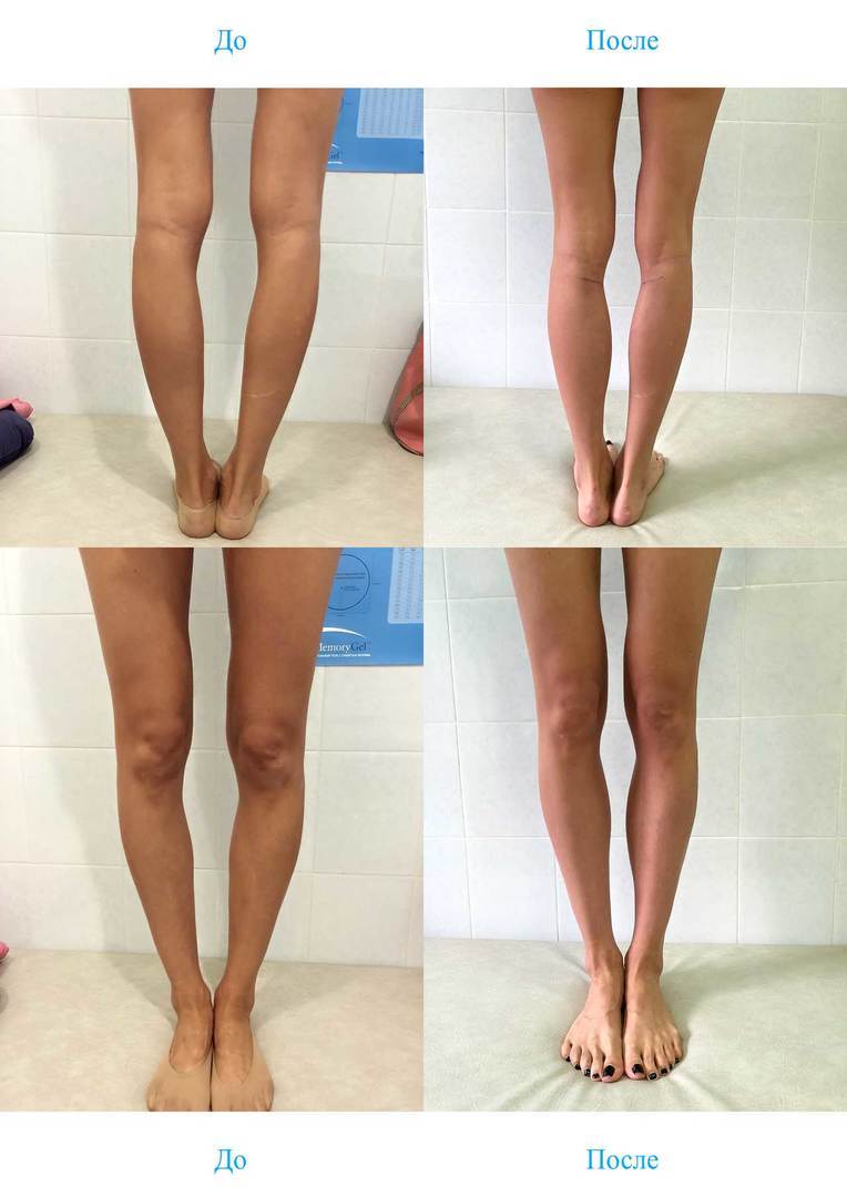 Круропластика ног. Круропластика (увеличение голени). Круропластика голени операция. Пластика ног (круропластика).